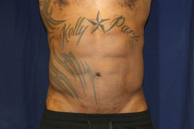 Liposuction & Safe Lipo Case 44 - After