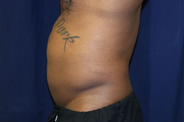 Liposuction & Safe Lipo: Case 44 - Before