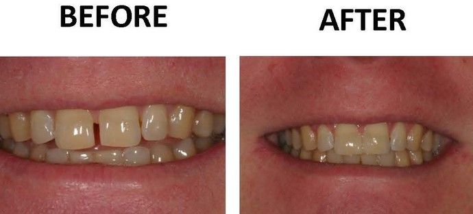 Before and After Gallery Cases