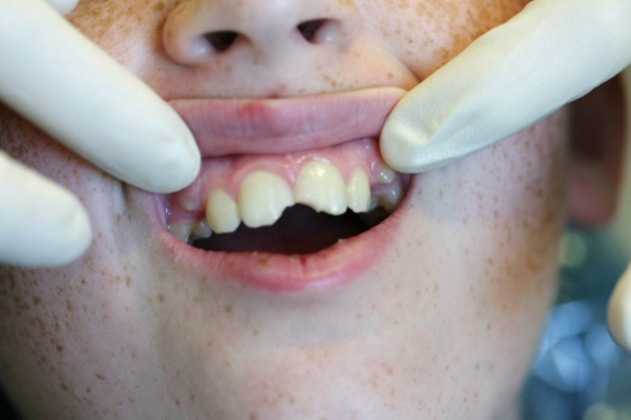 Before and After Gallery Case 1 Bonding - Before