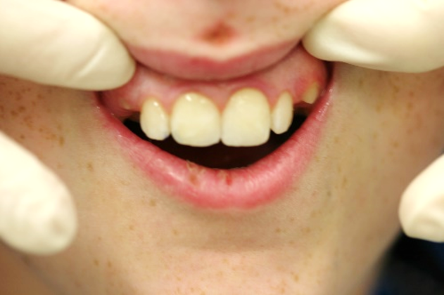 Before and After Gallery Case 1 Bonding - After