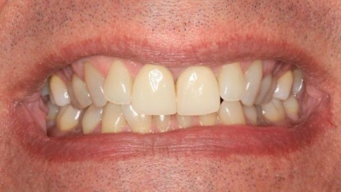 Porcelain Crowns: Case 8 - Before