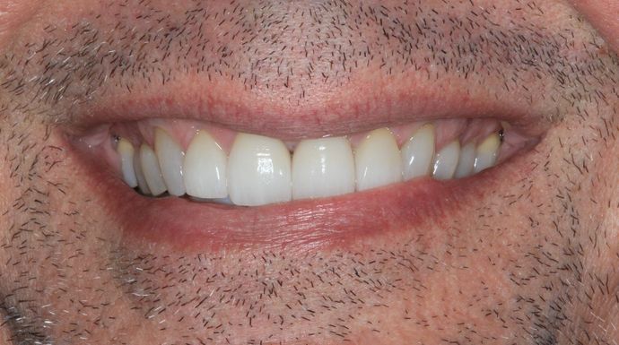 Porcelain Crowns: Case 8 - After