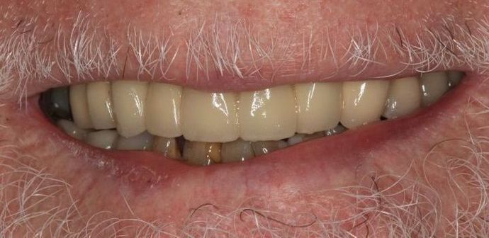 Porcelain Crowns: Case 10 - Before