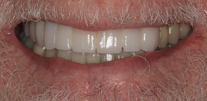 Porcelain Crowns: Case 10 - After