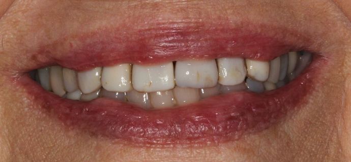 Porcelain Crowns Case 11 - Before