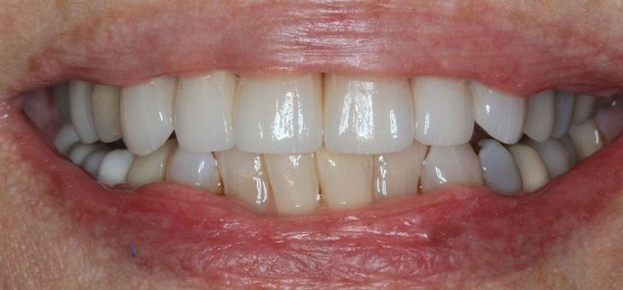 Porcelain Crowns Case 11 - After