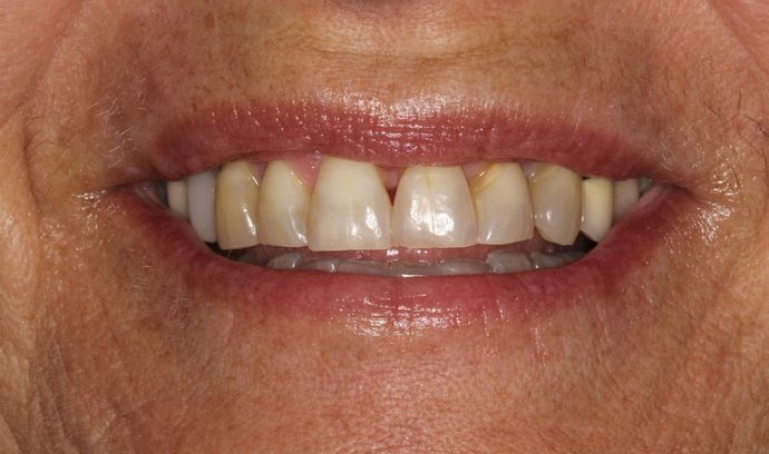 Porcelain Crowns: Case 12 - Before