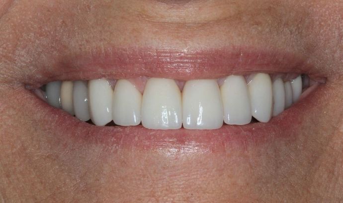 Porcelain Crowns: Case 12 - After