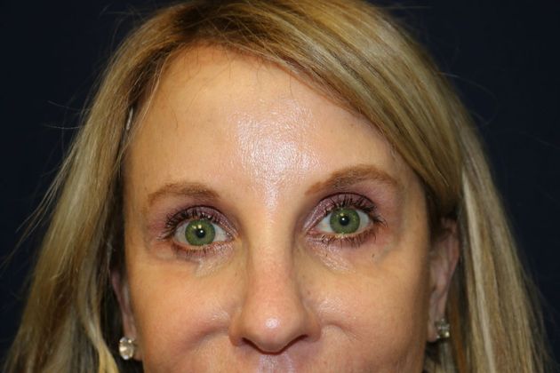 Cosmetic Injectables & Fillers*: Case 35 Undereye Filler - Before