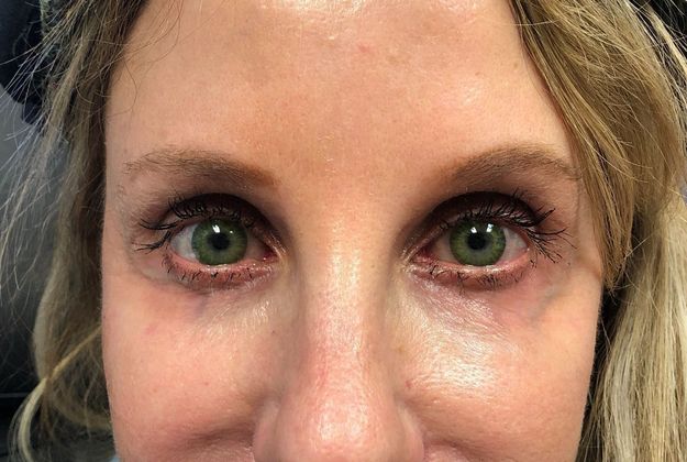 Cosmetic Injectables & Fillers*: Case 35 Undereye Filler - After