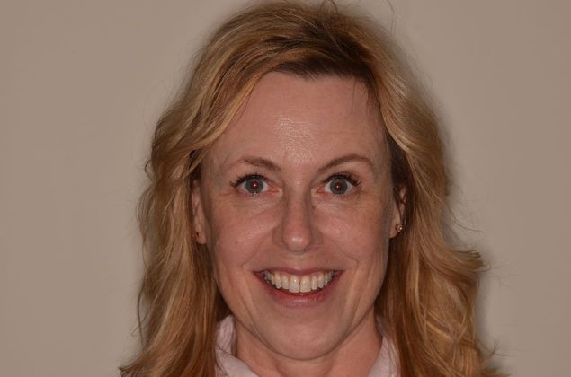 Invisalign: Case 14 - After