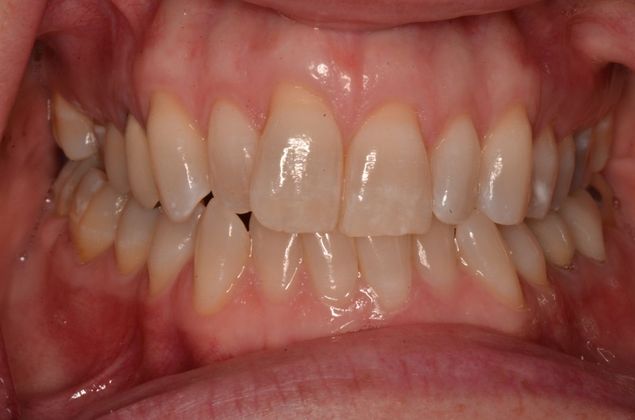 Invisalign: Case 14 - Before