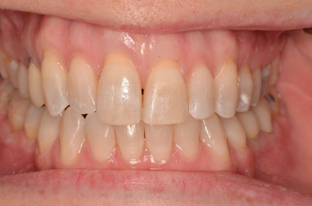 Invisalign: Case 14 - After