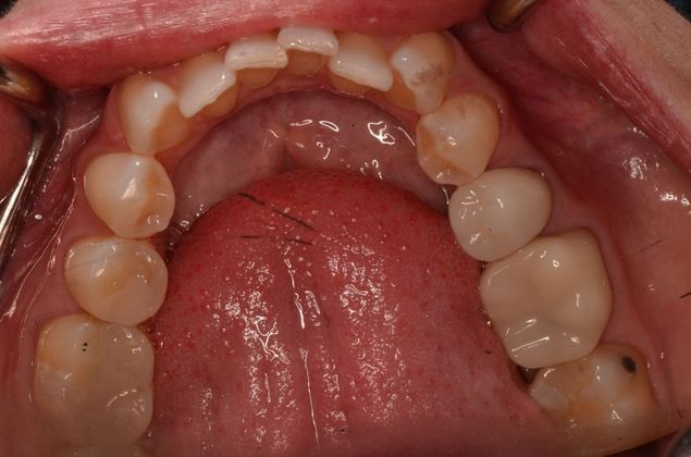 Invisalign: Case 14 - Before