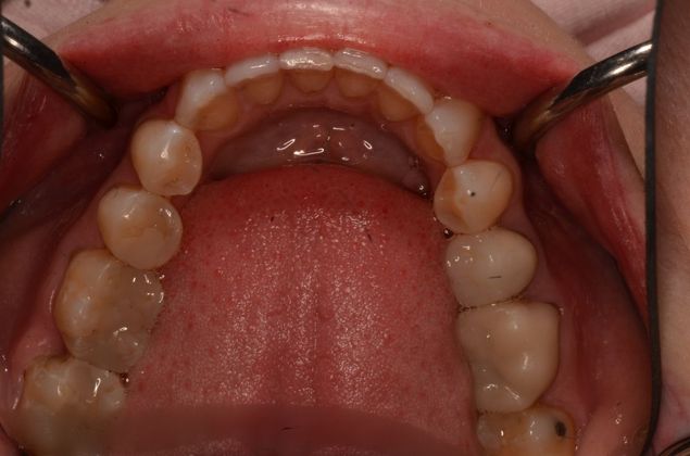 Invisalign: Case 14 - After