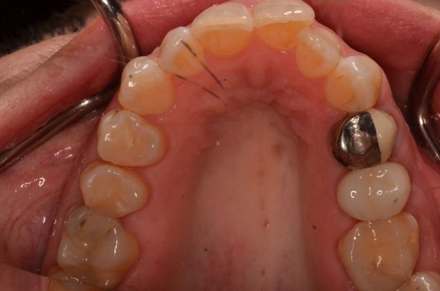 Invisalign: Case 14 - Before