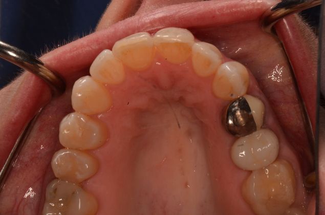 Invisalign: Case 14 - After