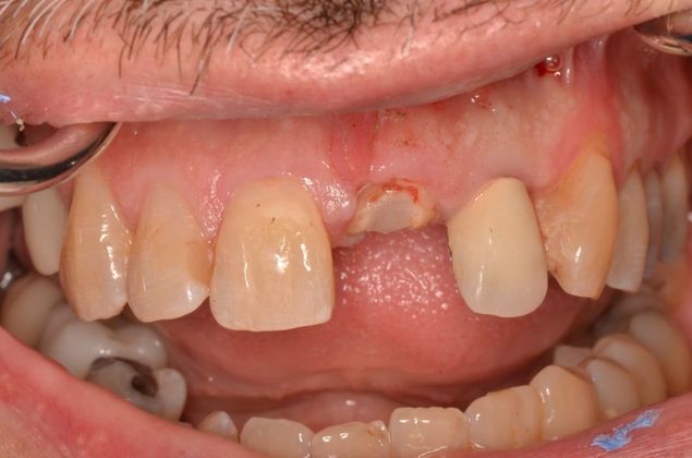 Dental Implants Case 43 - Before