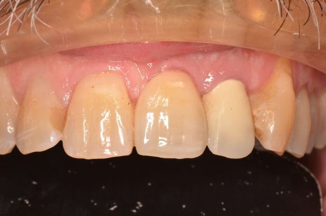 Dental Implants Case 43 - After