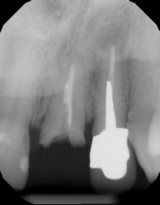 Dental Implants: Case 43 - Fractured tooth