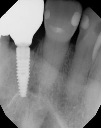 Dental Implants: Case 43 - After implant and crown