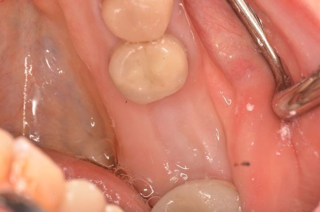 Dental Implants: Case 44 - Before