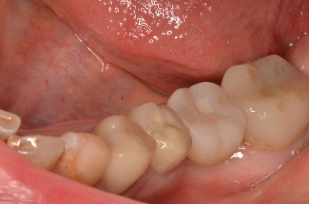 Dental Implants: Case 44 - After