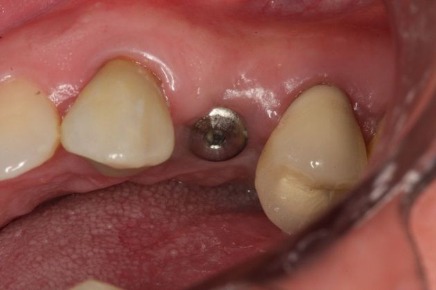 Cerec Case 5 - Before