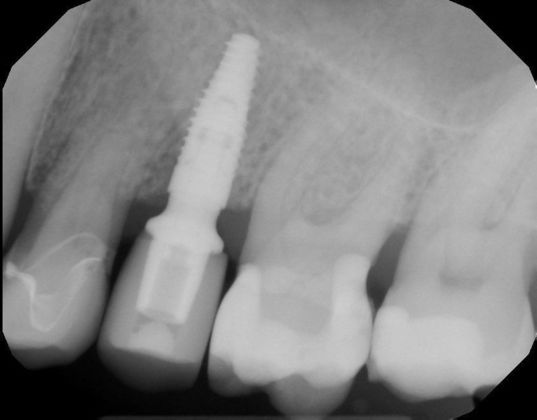Cerec Case 5 - After