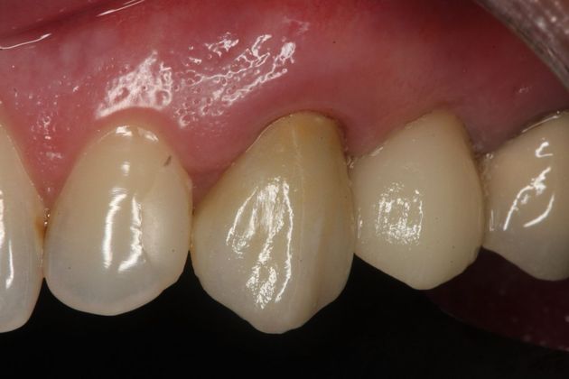 Cerec: Case 5 - After implant crown