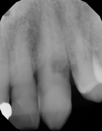 Internal and External root resorption Case 1 - Before