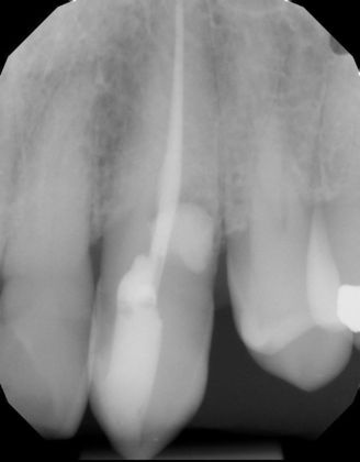 Internal and External root resorption Case 1 - After