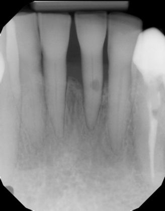 Internal and External root resorption Case 2