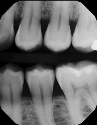 Internal and External root resorption Case 3 - Before