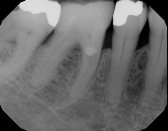 Internal and External root resorption Case 4