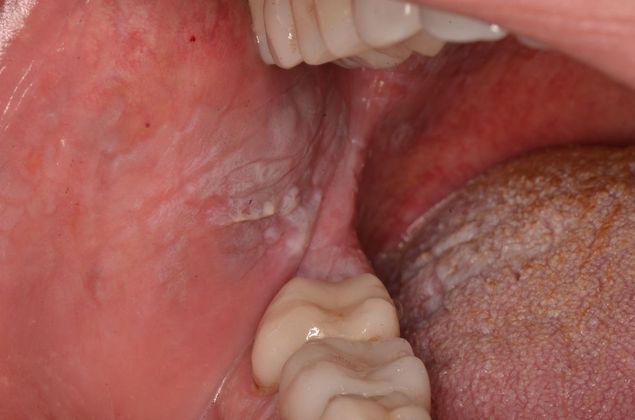 Dental Pathology Case 2 - Before