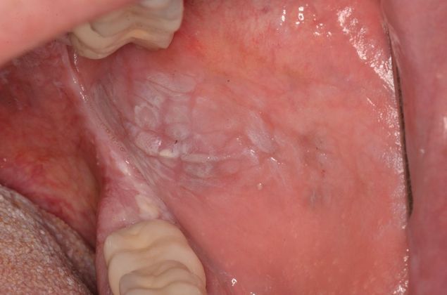 Dental Pathology Case 2 - After