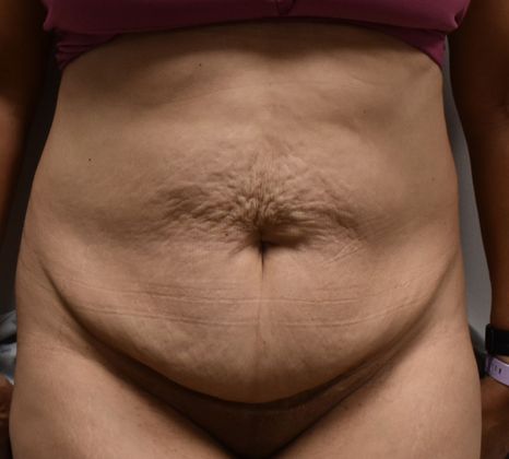 Tummy Tuck (Abdominoplasty): Case 278 - Before