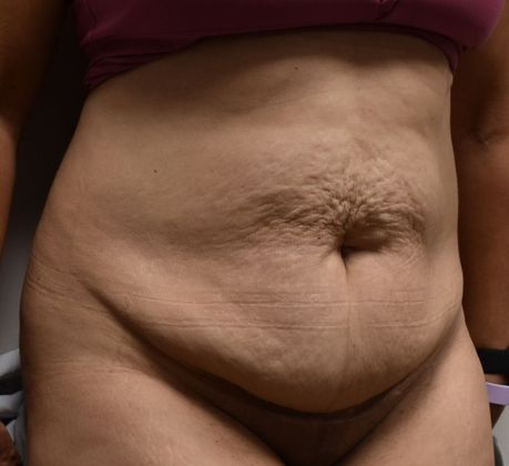 Tummy Tuck (Abdominoplasty): Case 278 - Before