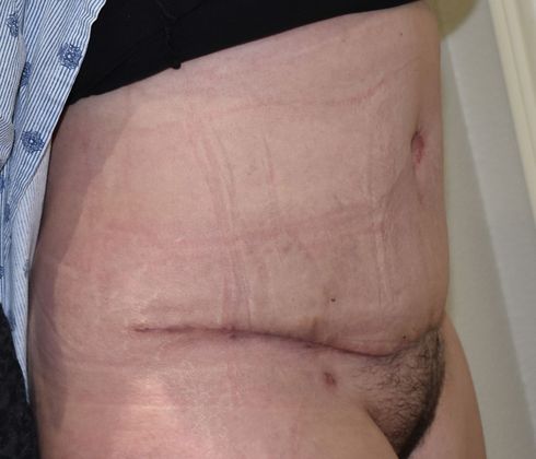 Tummy Tuck (Abdominoplasty): Case 279 - After