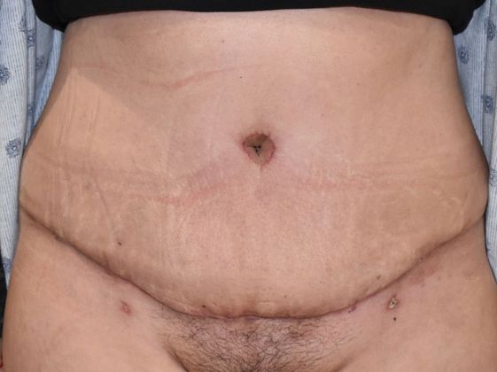 Tummy Tuck (Abdominoplasty): Case 279 - After
