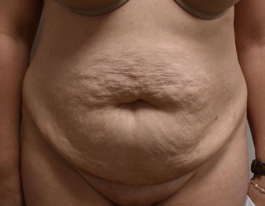 Tummy Tuck (Abdominoplasty): Case 279 - Before