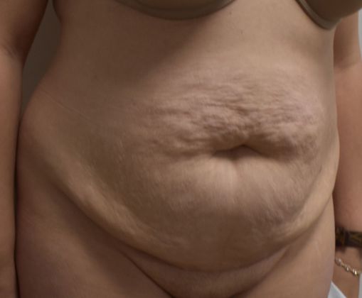 Tummy Tuck (Abdominoplasty): Case 279 - Before
