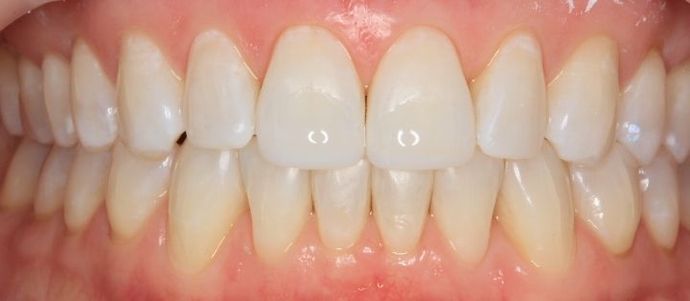 Bonding Case 2 - After