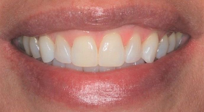 Bonding Case 3 - After