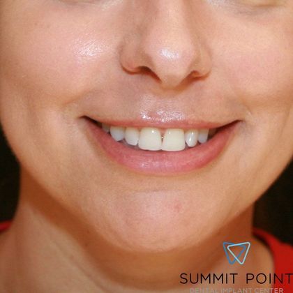 Veneers Case 2 - Before