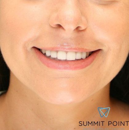 Veneers Case 2 - After