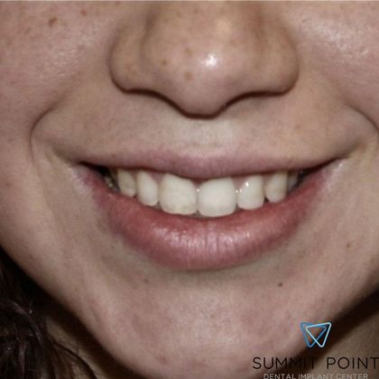 Veneers Case 3 - Before