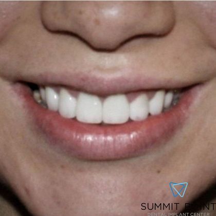 Veneers Case 3 - After